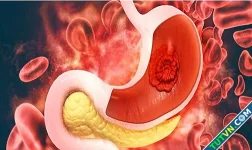 Xuất huyết tiêu hóa