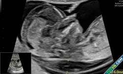 Thai nhi mắc cùng lúc hai đột biến gene
