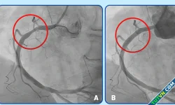 Nhồi máu cơ tim do bóc tách động mạch vành