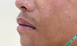 Bỏng da do tắm nắng