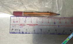 Bé trai nhét bút chì 8 cm vào hậu môn