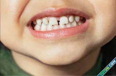 3 sai lầm khi chăm sóc răng sữa ở trẻ