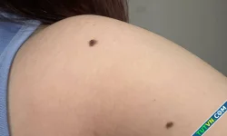 Dấu hiệu nhận biết nốt ruồi có nguy cơ ung thư