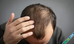 Rụng tóc mảng - bệnh dễ gây tổn thương tâm lý