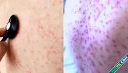 Các bệnh có triệu chứng dễ nhầm với sởi