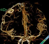 Dị dạng mạch máu não cướp tính mạng người trẻ