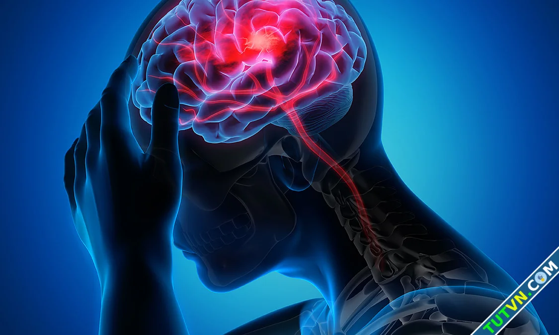 Đột quỵ gia tăng ở người trẻ toàn thế giới-1.webp