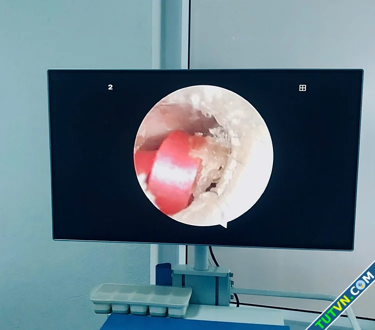 Sợi dây buộc tóc suýt gây thủng màng nhĩ bé gái-1.webp