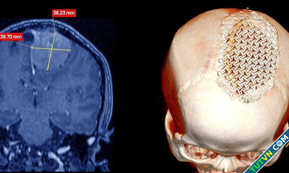 Vá sọ bằng lưới titan cho người bệnh u não-1.webp