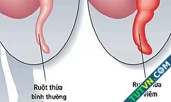 Viêm ruột thừa cấp-1.webp