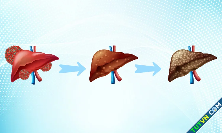 Virus viêm gan B phá hủy gan thế nào-1.webp